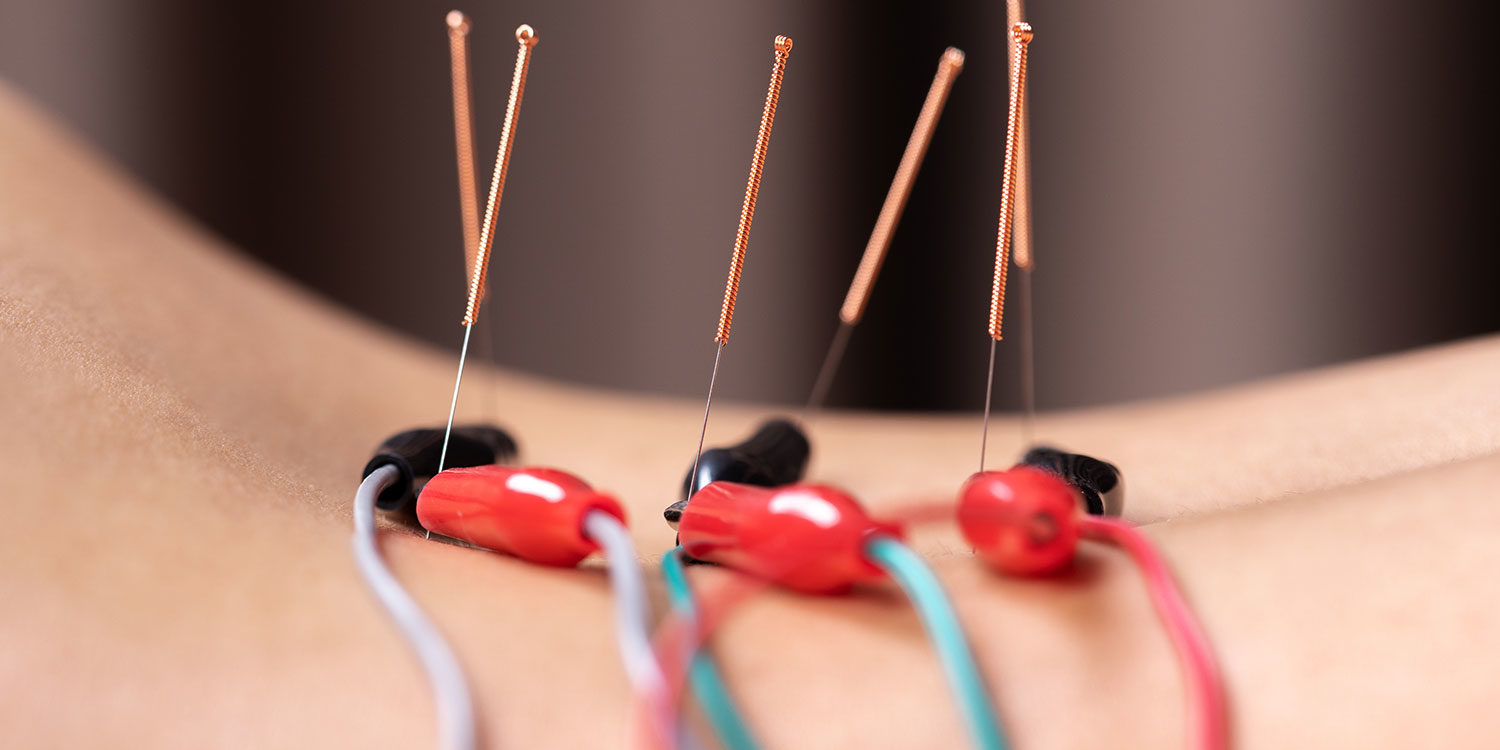 electric-acupuncture